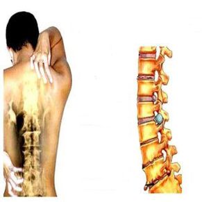 Matakai na osteochondrosis