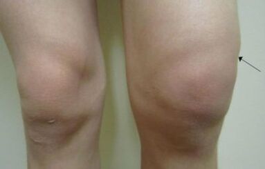 Bayanin asibiti bayyana na arthrosis na gwiwa hadin gwiwa