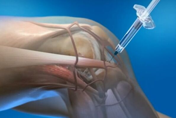 Alamar Intra -tarticular don Arthrosis na gwiwa hadin gwiwa