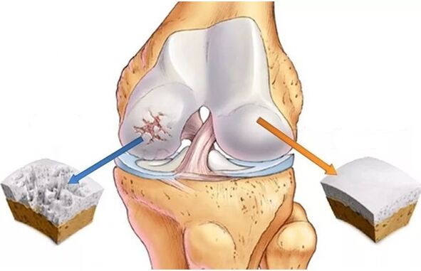Lafiya carilage da guringuntsi wanda aka kare ta hanyar arthrosis ya shafa