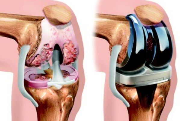 kafin da bayan endopratostics na gwiwa hadin gwiwa tare da arthrosis