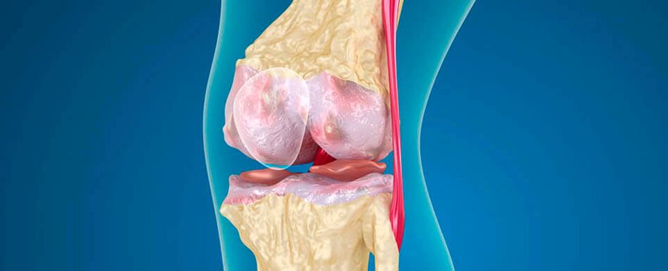 arthrosis na gwiwa gwiwa