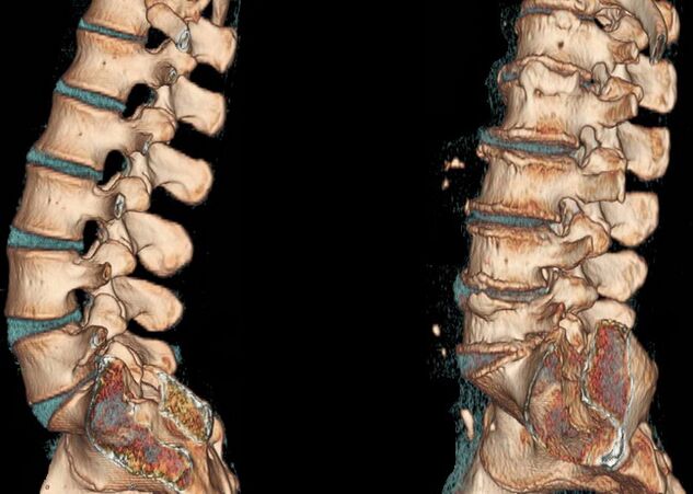 Osteochondrosis na kashin baya a kan CT scan