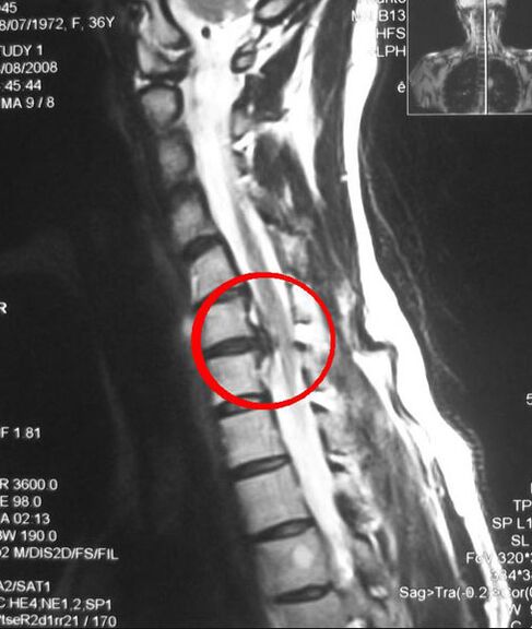 Alamun osteochondrosis na thoracic akan x-ray